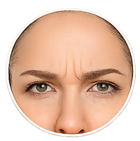 Kaş arası çizgileri botox bölgesi