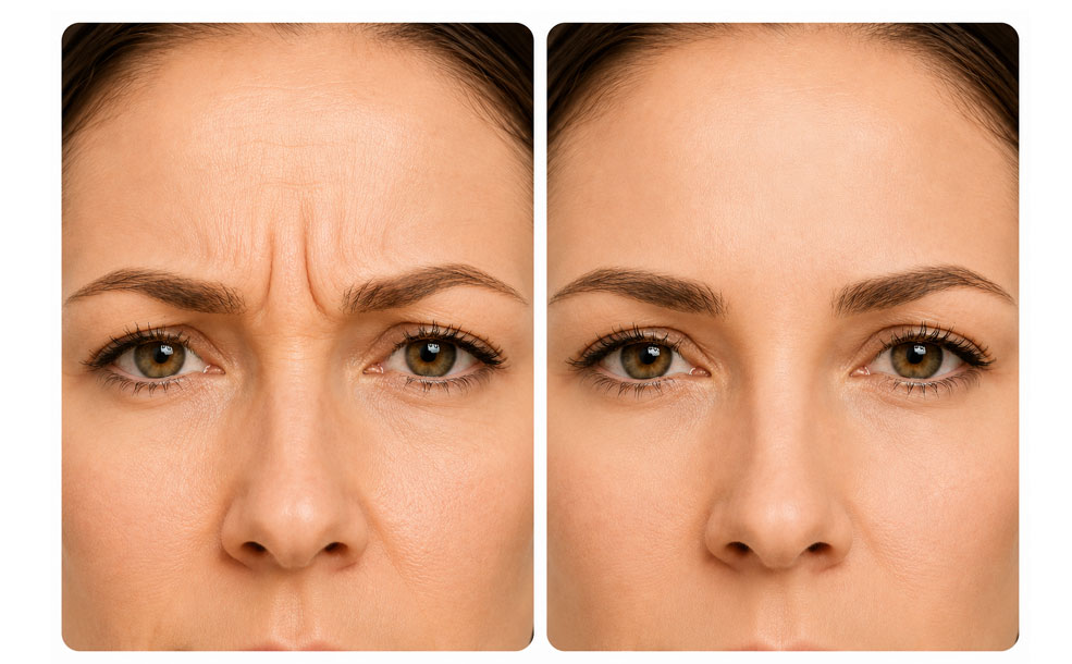 Botox öncesi ve sonrası görünüm